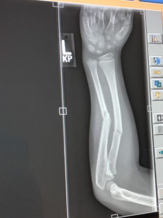 Picture showing x-ray of our 7 year old's broken arm